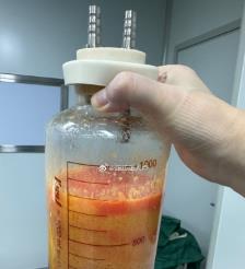 台山水动力吸脂手术要做多久？